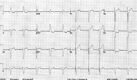 Left Ventricular Hypertrophy (LVH) • LITFL • ECG Library Diagnosis